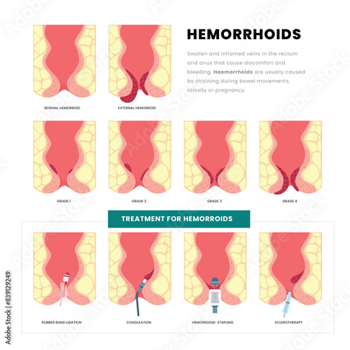 Different types of hemorrhoids disease educational poster with grade and treatment infographic, Pectinate line and Rectal bleeding, Stage of internal piles, vascular prolapse in the anal canal.