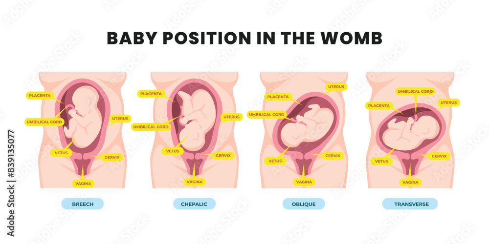 Different baby positions in the womb during pregnancy, Cephalic, Breech, transverse, Oblique lies. Colored medical poster diagram banner. Fetus with umbilical cord and placenta Different baby positions in the womb during pregnancy, Cephalic, Breech, transverse, Oblique lies. Colored medical poster diagram banner. Fetus with umbilical cord and placenta