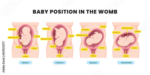 Different baby positions in the womb during pregnancy, Cephalic, Breech, transverse, Oblique lies. Colored medical poster diagram banner. Fetus with umbilical cord and placenta