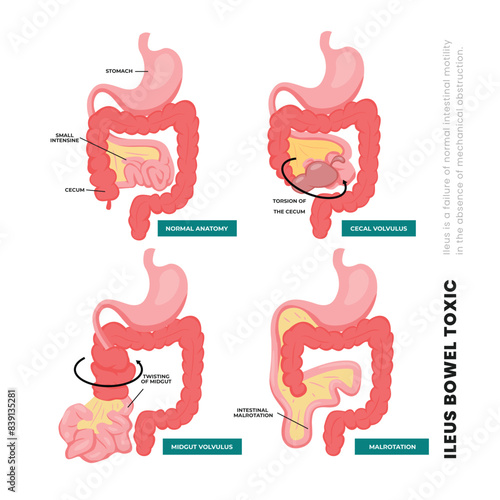 Set of different types of ileus bowel toxic poster scheme, with normal anatomy, cecal volvulus, midgut volvulus, malrotation, Irritable bowel syndrome, constipation, intestinal obstruction.