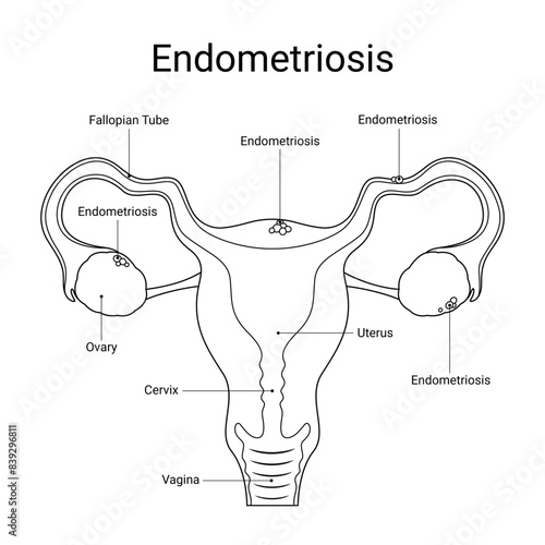 Illustration of endometriosis disease with design line style for medical