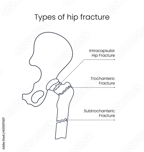 Types of human fracture in line style design