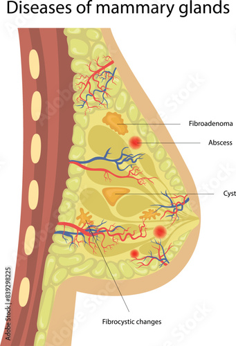 Of breast disease. Breast disease.