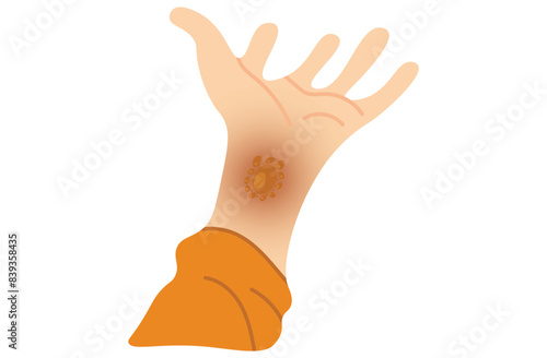 Autoimmune progesterone dermatitis,urticaria,Bullous pemphigoid,herpetiformis,Dermatomyositis,Epidermolysis bullosa acquisita,Gestational,Hidradenitis suppurativa,Lichen planus,Linear IgA,Pain