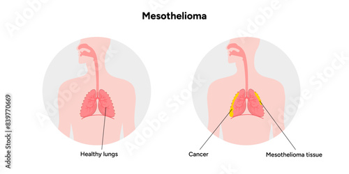Mesothelioma disease, lung problems, healthy lungs