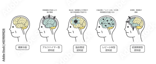 高齢者が認知症によって損傷を受ける脳の部分とその名称のイラストのセット