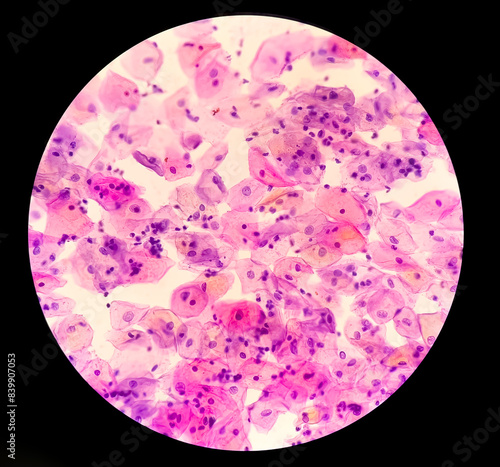 Atypical squamous cells of undetermined significance, it may be a sign of infection with certain types of human papillomavirus (HPV) or other types of infection, such as a yeast infection. photo