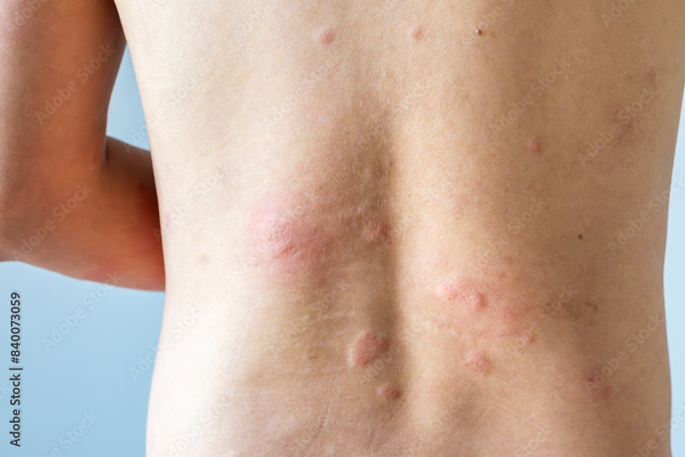 Young asian man itching and scratching on his back from allergic itchy dry skin eczema dermatitis insect bites Young asian man itching and scratching on his back from allergic itchy dry skin eczema dermatitis insect bites