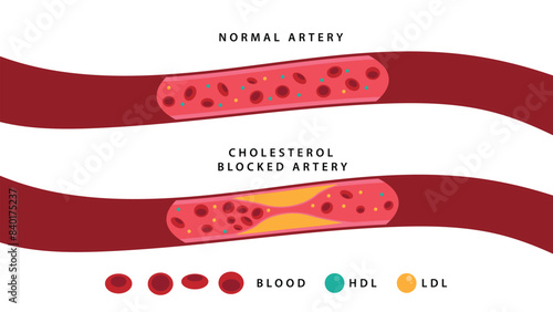 Types of cholesterol blood flow. Normal, Blocked artery. High-Density Lipoprotein (HDL) and Low-Density Lipoprotein (LDL). Vector illustration