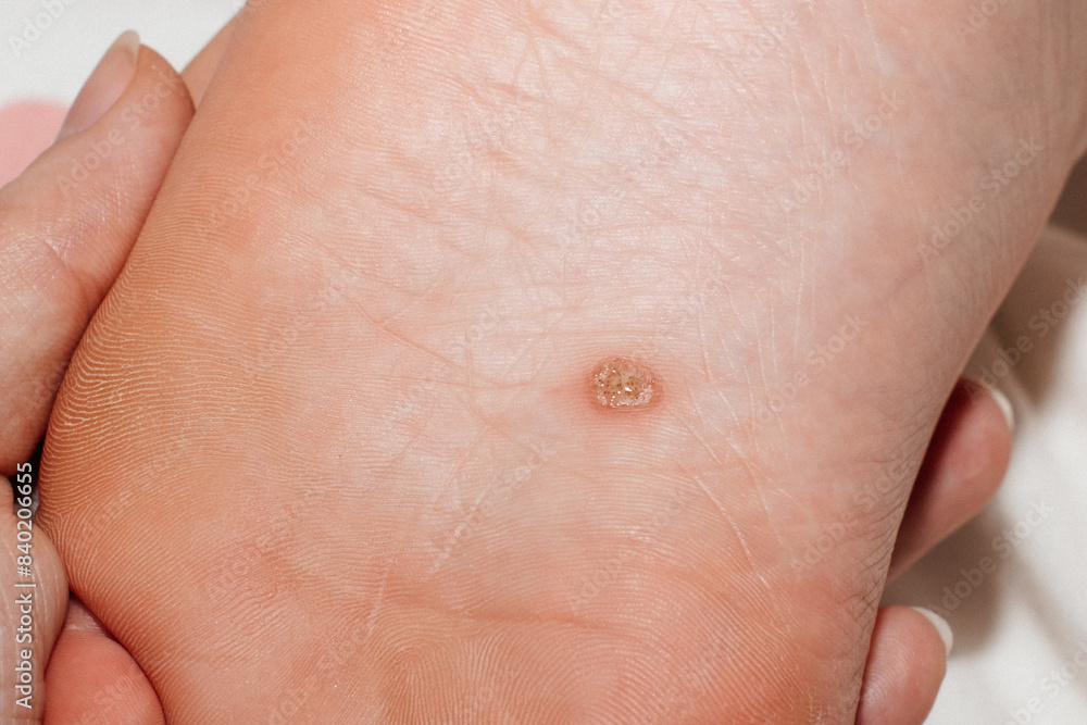 Close-up of an extensive wart on a child's foot Close-up of an extensive wart on a child's foot