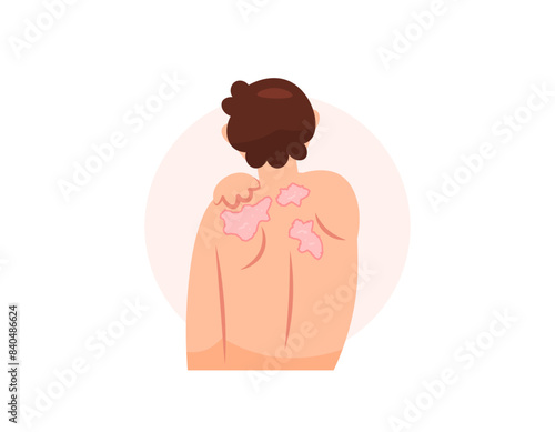 illustration of a man who feels itchy on his back and shoulders. suffering from ringworm or Dermatophytosis, a fungal infection. skin disease. health problems. character design. flat style