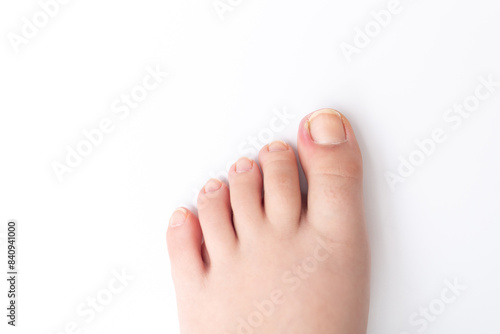 an ingrown toenail on a child, visible signs of inflammation include redness