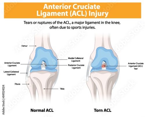 Comparison of normal and torn ACL in the knee