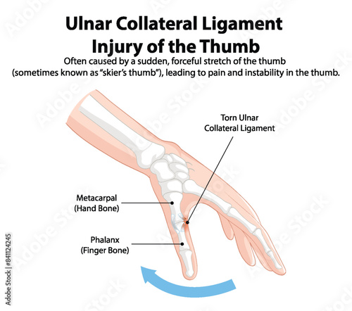Illustration of thumb ligament injury and affected bones