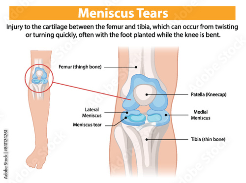 Illustration of knee anatomy and meniscus tear