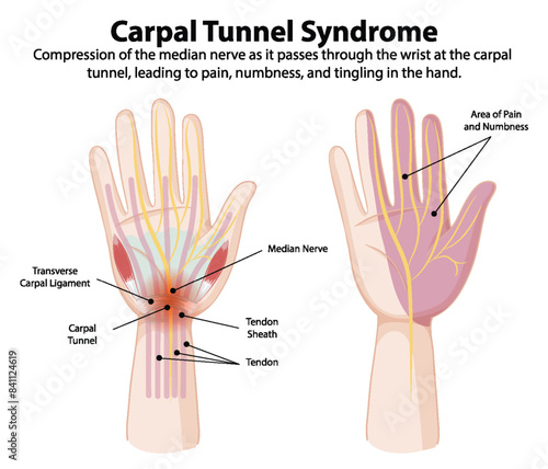 Diagram showing carpal tunnel syndrome symptoms