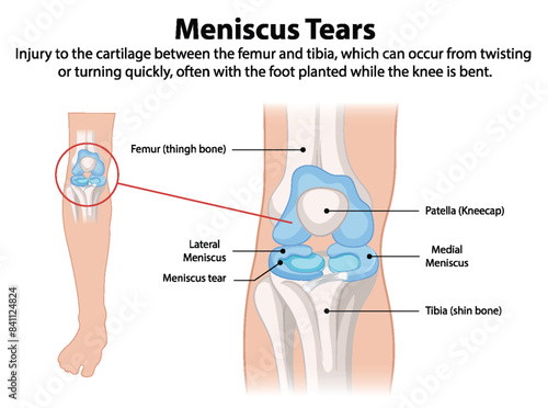 Illustration of knee meniscus tear anatomy