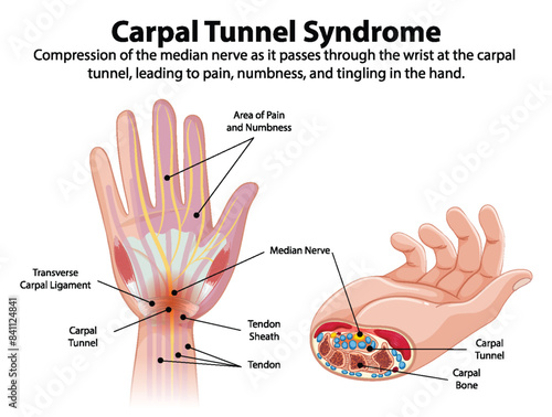 Detailed diagram of carpal tunnel syndrome symptoms