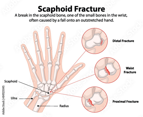 Detailed diagram of scaphoid bone fractures