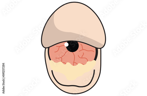 Mucous membrane pemphigoid,Cicatricial,chronic autoimmune causing blistering and scarring of the mucous membranes, including the eyes,Stevens-Johnson syndrom,ocular,Mooren's ulcer,vectors