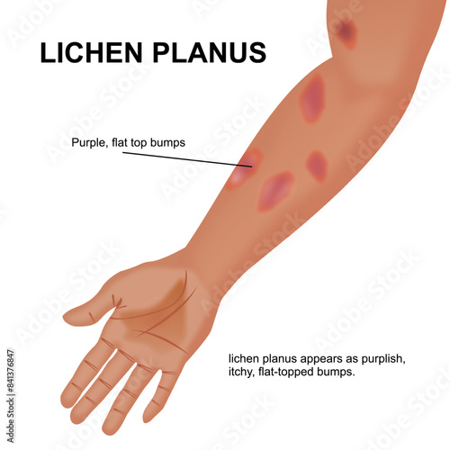 Lichen ruber planus skin illustration
