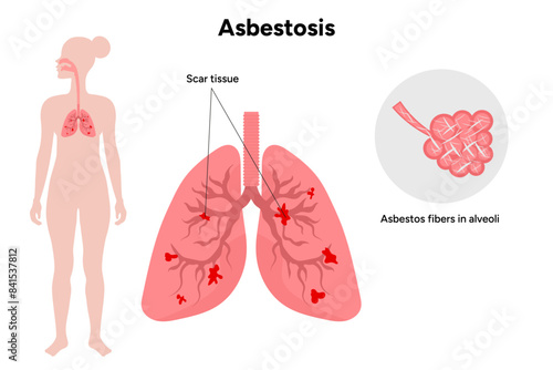 Asbestos-related diseases