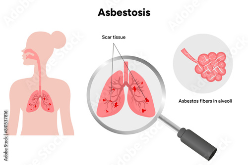 Asbestos-related diseases