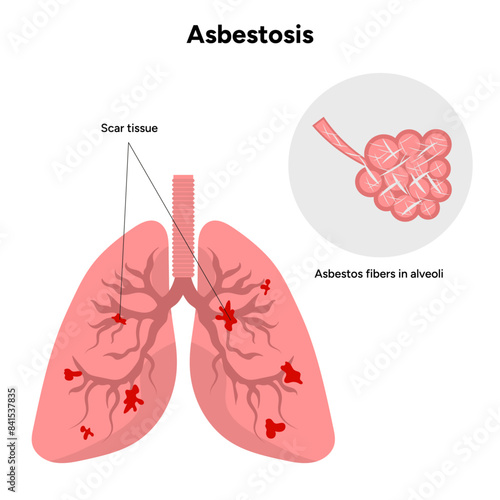 Asbestos-related diseases