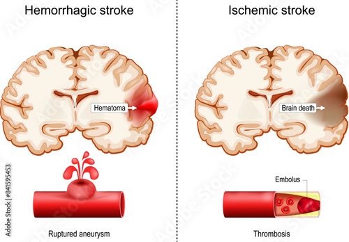 Hemorrhagic and Ischemic strokes.