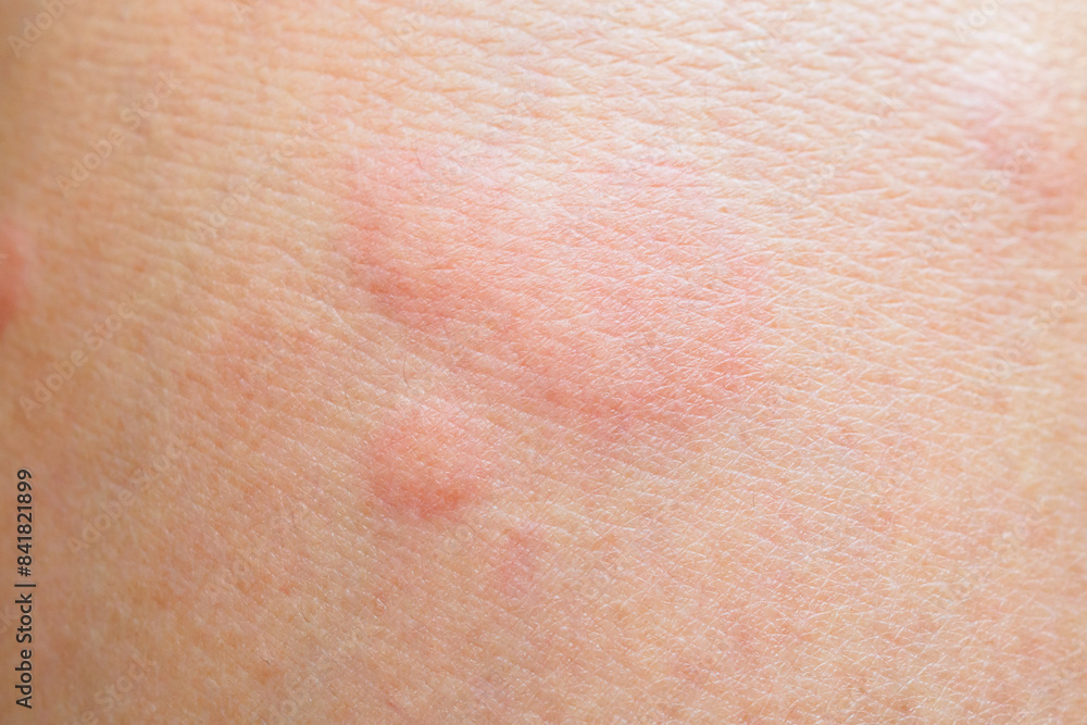 Fototapeta premium Skin allergy rash dermatitis texture close up background