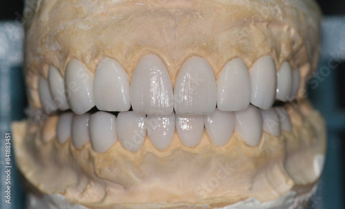 Wallpaper Mural Dental veneersin the plaster model for the dentist to fix to the patient Torontodigital.ca