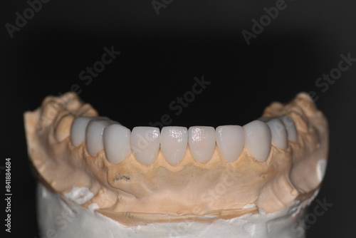 Wallpaper Mural Dental veneersin the plaster model for the dentist to fix to the patient Torontodigital.ca