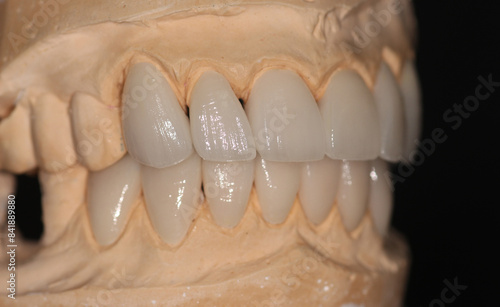 Wallpaper Mural Dental veneersin the plaster model for the dentist to fix to the patient Torontodigital.ca