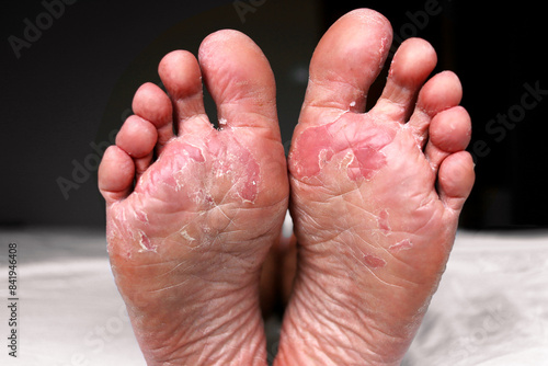 Close up of dry feet. Peeling and cracked foot. Fungal infection or athlete's foot, dry skin, dermatitis, eczema, psoriasis, sweaty feet or dehydration. Health care concept.