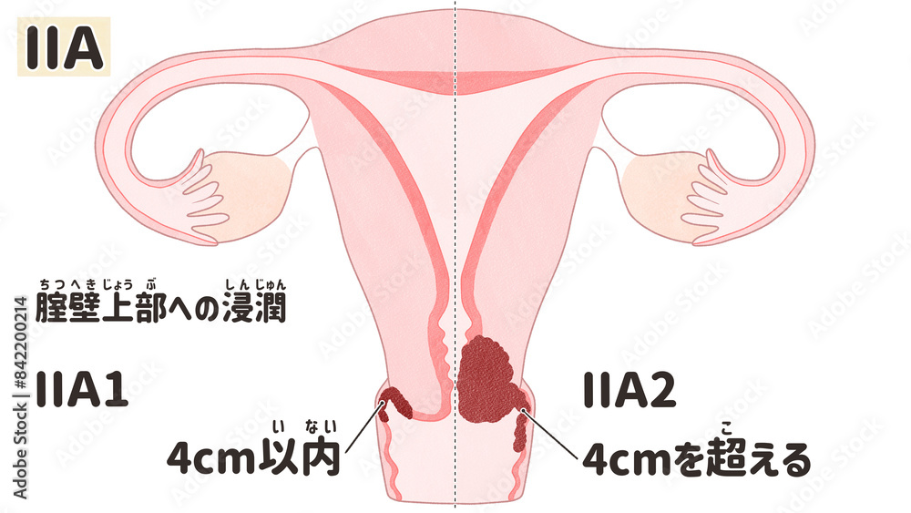 Obraz premium Cervical cancer stage 2A diagram PNG