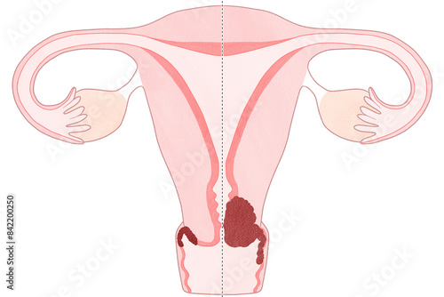 Blank cervical cancer stage 2A diagram PNG
