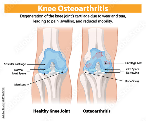Healthy knee joint versus osteoarthritis-affected knee joint