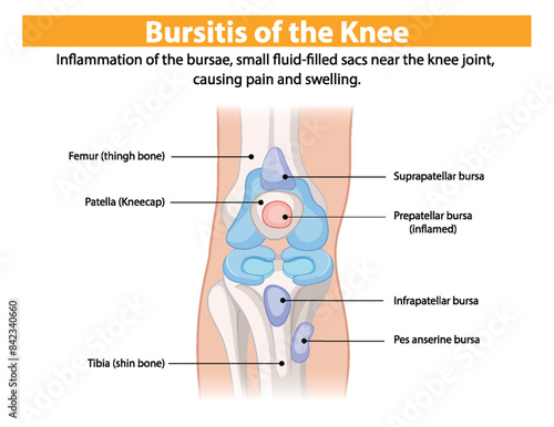 Inflammation of knee bursae causing pain and swelling