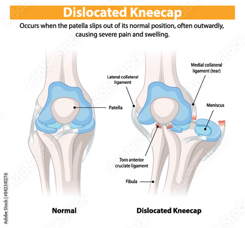 Comparison of normal and dislocated kneecap