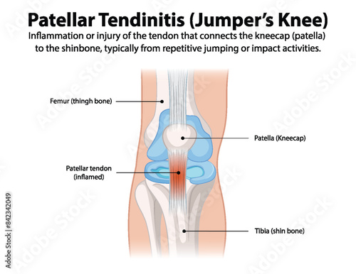 Diagram of knee showing patellar tendinitis
