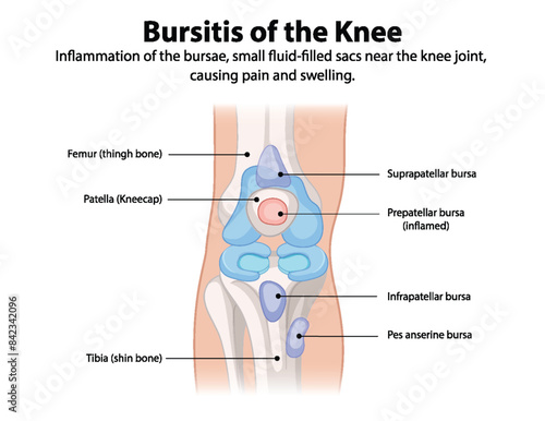 Inflammation of knee bursae causing pain and swelling