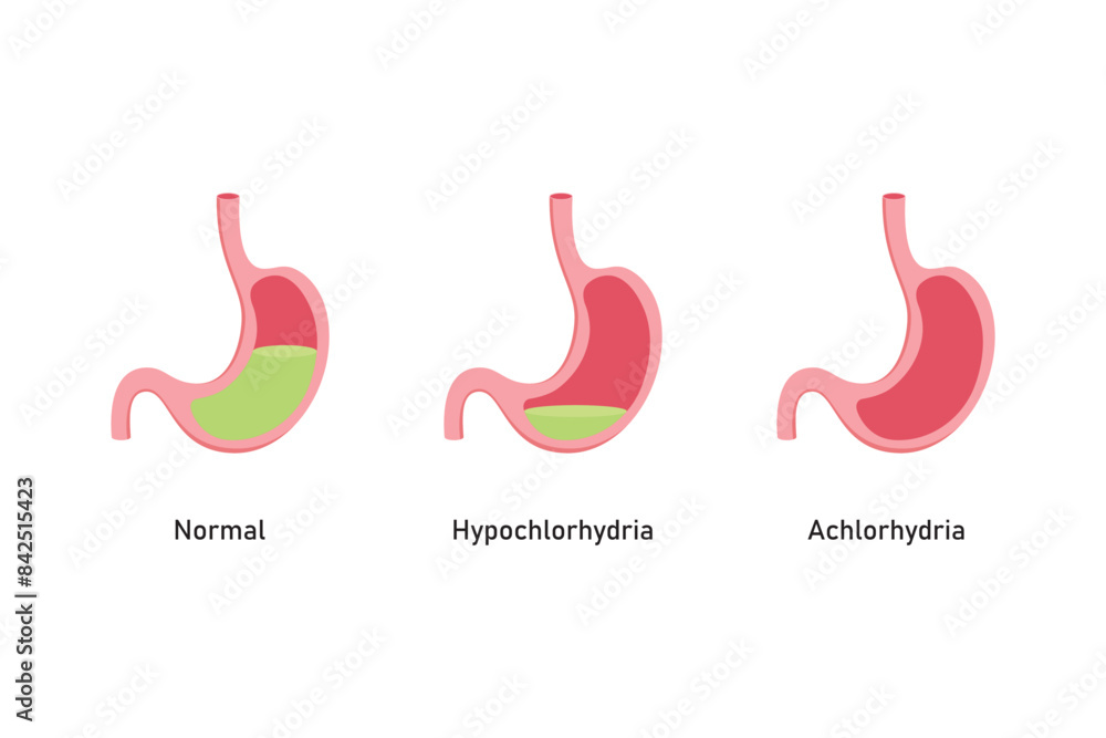 Fototapeta premium Hypochlorhydria and Achlorhydria Scientific Design. Vector Illustration.