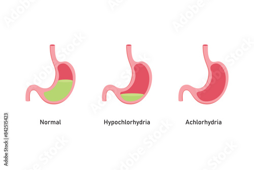 Hypochlorhydria and Achlorhydria Scientific Design. Vector Illustration.