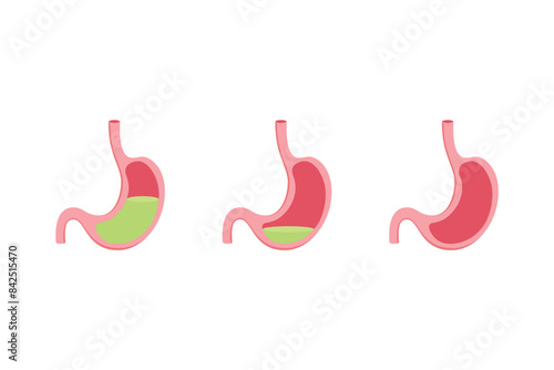 Hypochlorhydria and Achlorhydria Scientific Design. Vector Illustration.