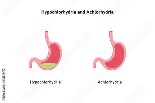 Hypochlorhydria and Achlorhydria Scientific Design. Vector Illustration.