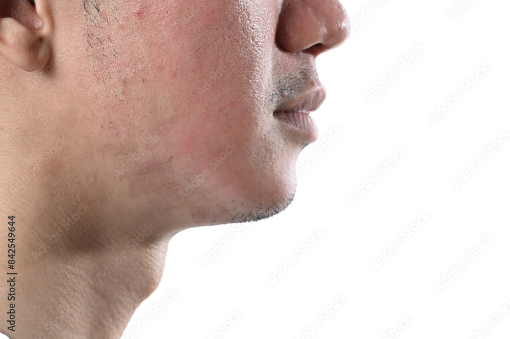 Man undergoing CO2 laser resurfacing for facial rejuvenation isolate on white background Man undergoing CO2 laser resurfacing for facial rejuvenation isolate on white background
