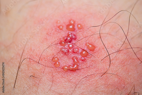 Obraz na plátně skin rash and blisters on body
(Shingles,herpes zoster)