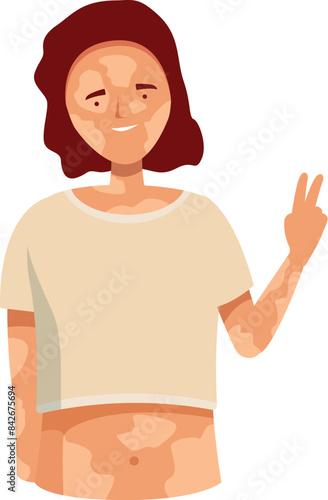 Young woman is showing her vitiligo skin and smiling, body positive, self acceptance and skin pigmentation disorders concept