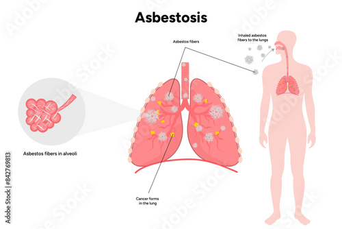 Asbestosis lungs diseases, lungs problem