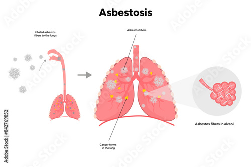 Asbestosis lungs diseases, lungs problem